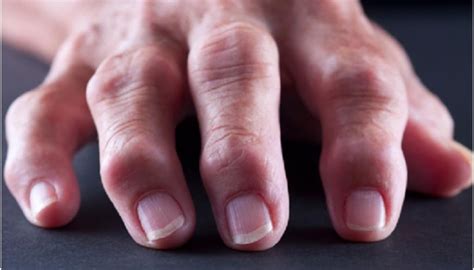 артрит или артроза на пръстите на краката